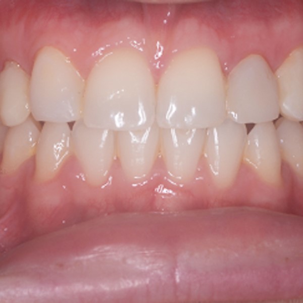 Invisalign Case Study aftre