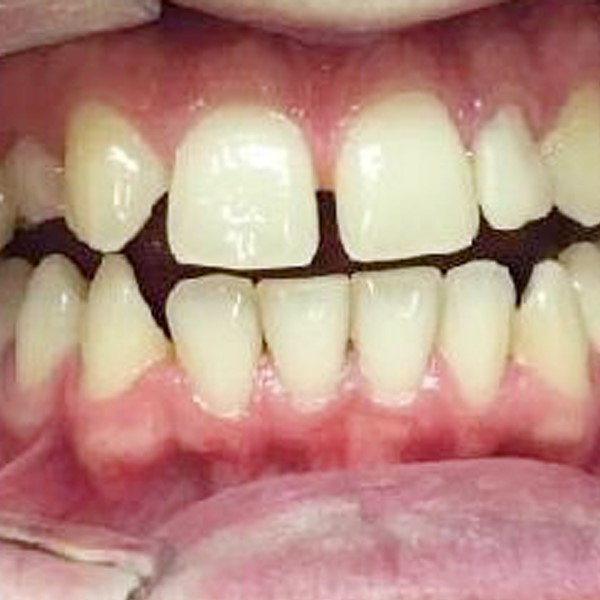 Invisalign Case Study beore