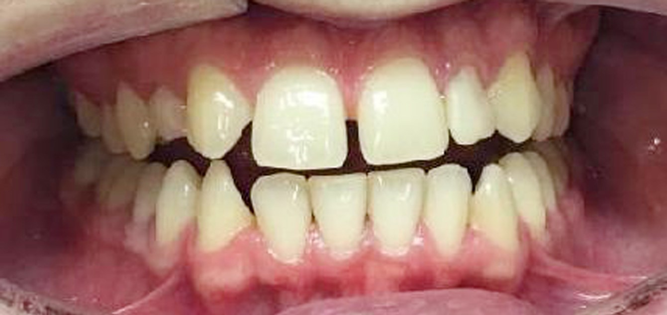 Invisalign-after